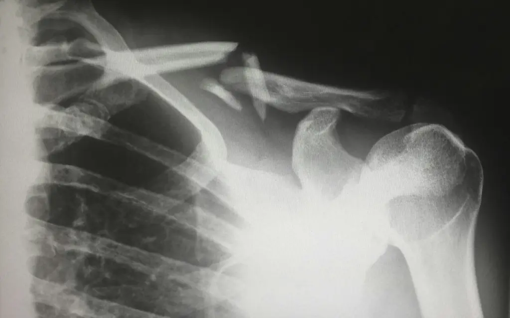 An X-ray image of a shoulder joint